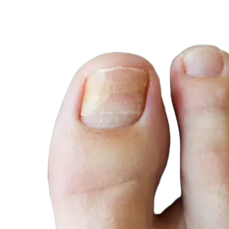 Onicolisi: cura dell’unghia sollevata